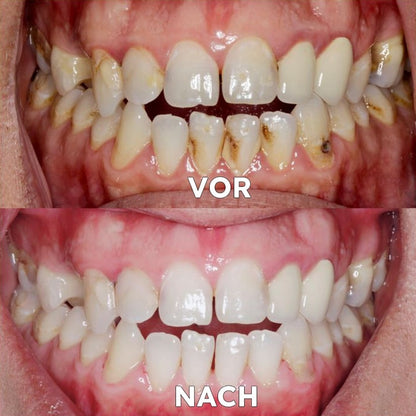 Mineralpulver für Zahnpflege | Zähne Stärken & Schützen | SmileSchutz
